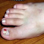 050715_MelBrokenToeProgress1