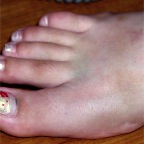050715_MelBrokenToeProgress2