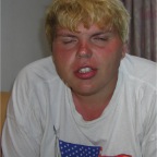 050720_Mick-Sunburn1