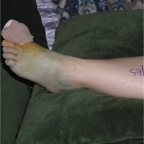 061011-Mel-BrokenToe-Yes