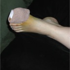 061012-Mel-BrokenToe-Progress