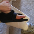 061121-BrokenToeDeviceRemoved